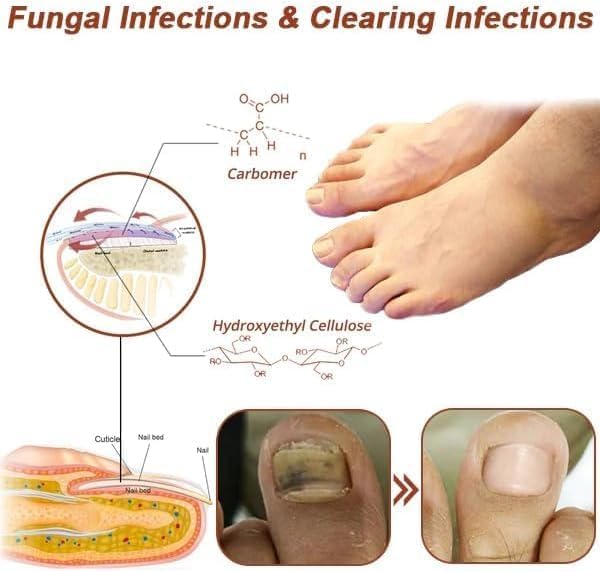 Revolutionäres, hocheffizientes Lichttherapiegerät für Zehennagelerkrankungen, Lichttherapie bei Nagelpilz, Nagelreinigung und -pflege (1 Stück)