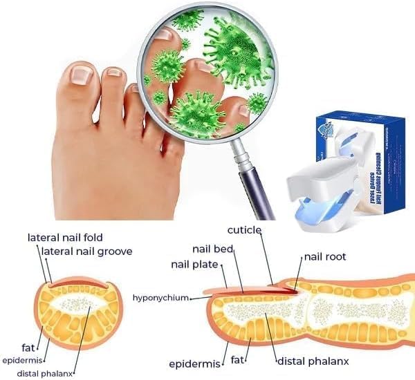 Revolutionäres, hocheffizientes Lichttherapiegerät für Zehennagelerkrankungen, Lichttherapie bei Nagelpilz, Nagelreinigung und -pflege (1 Stück)